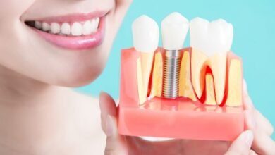 Dental Implants Cost