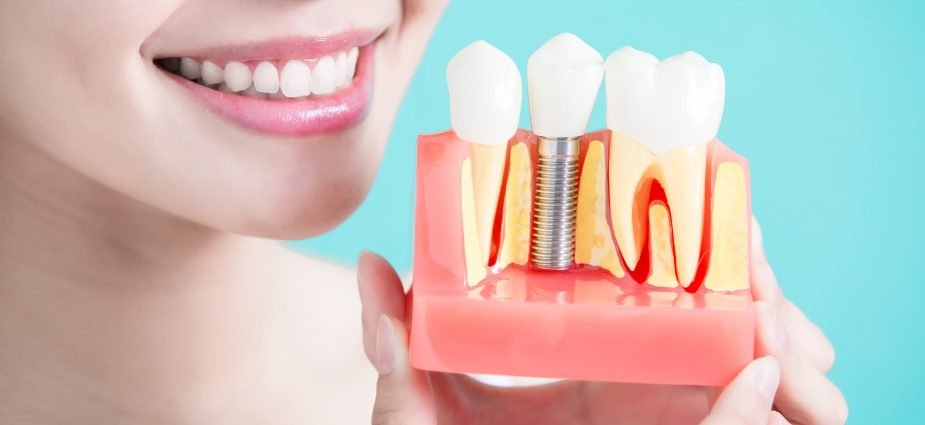 Dental Implants Cost: A Comprehensive Guide to Pricing, Benefits, and FAQs